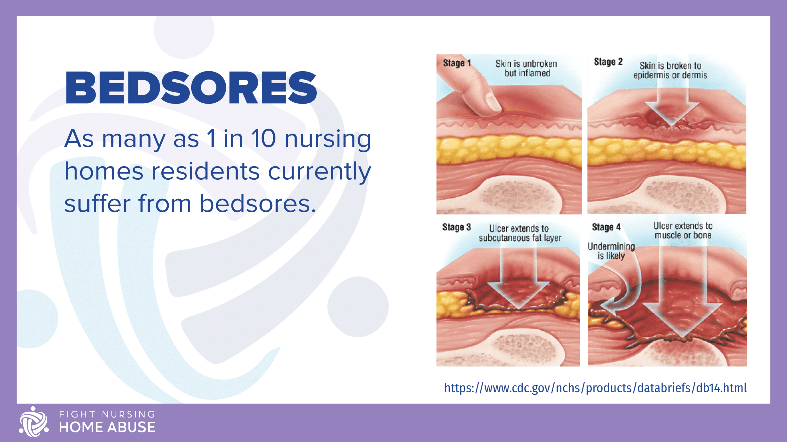 bedsores