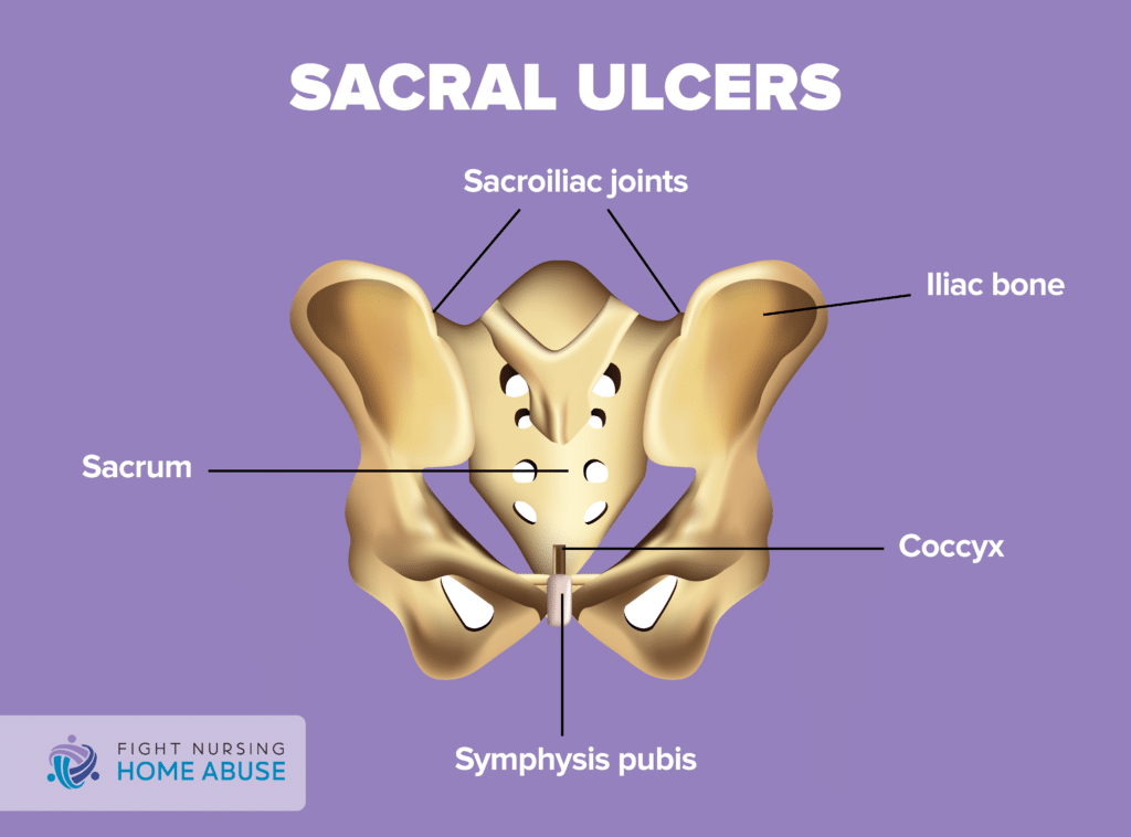 Sacral Ulcers