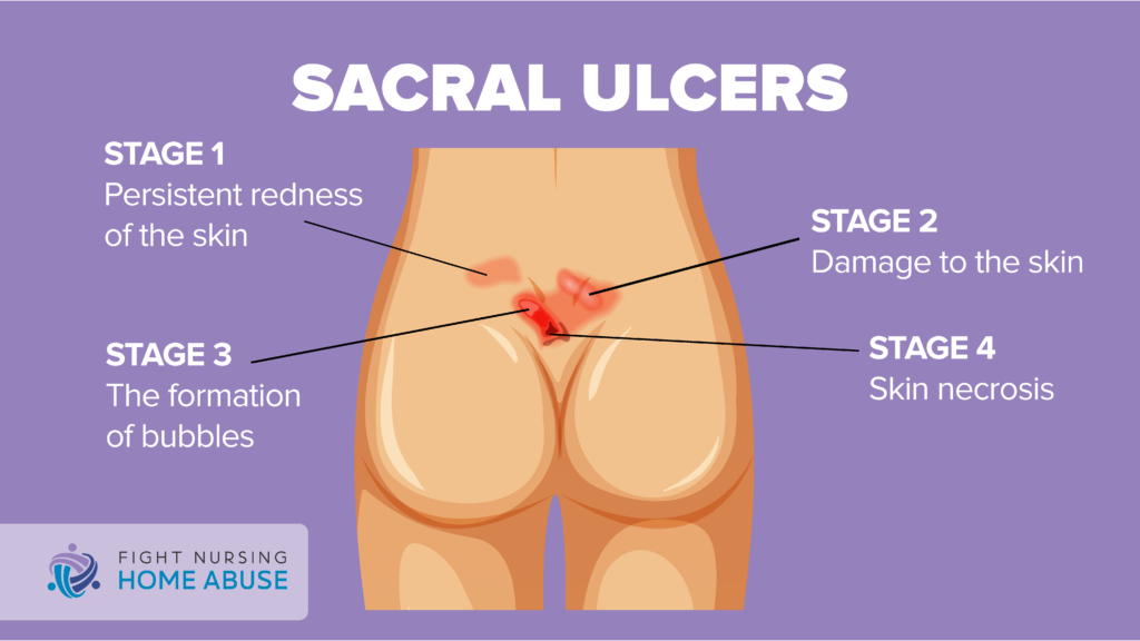 Sacral Ulcers
